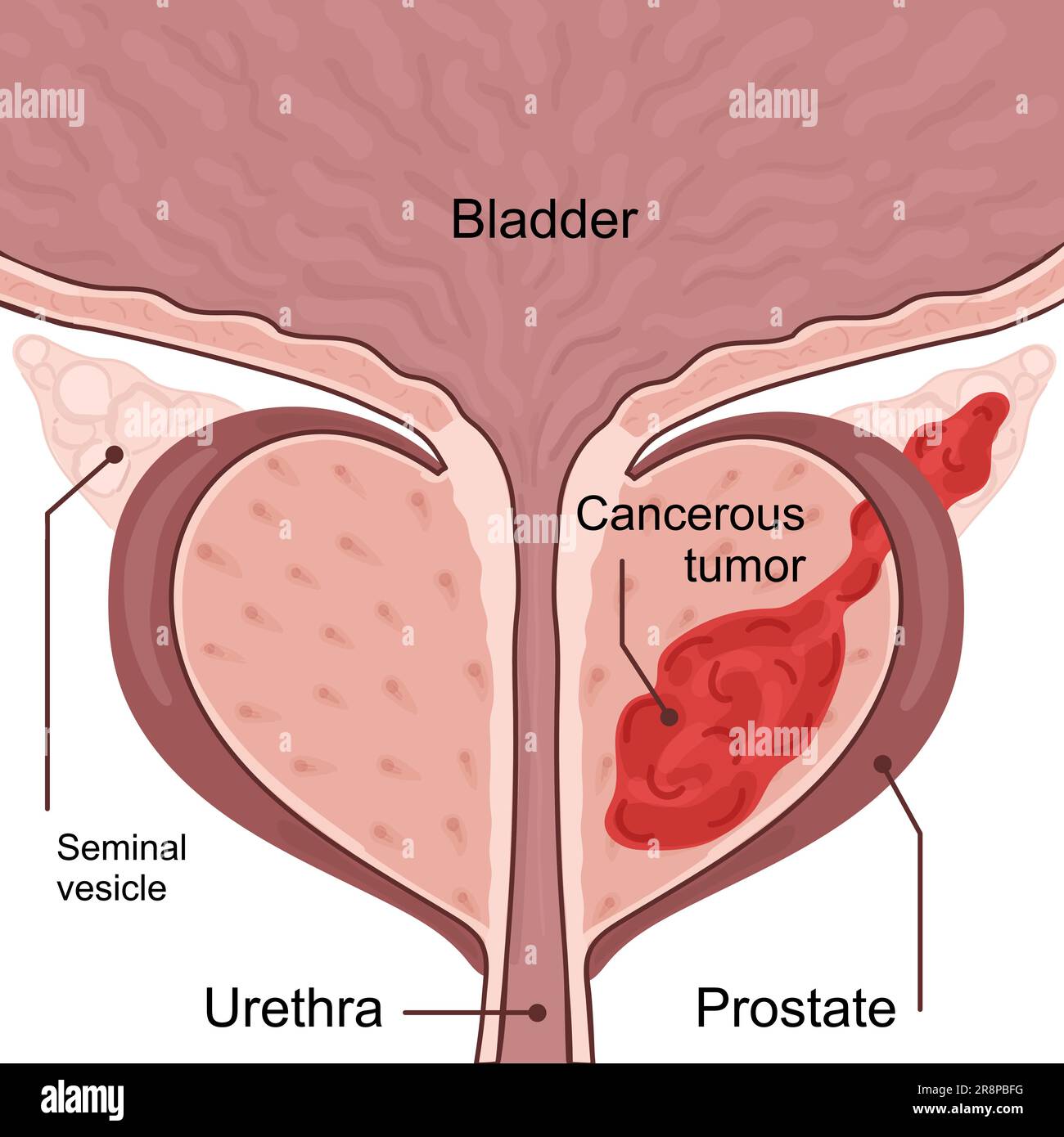 Schéma médical des 3 stades du cancer de la prostate. la tumeur se développe et pénètre dans les organes et tissus voisins. De la petite tumeur à la vessie atteinte Illustration de Vecteur