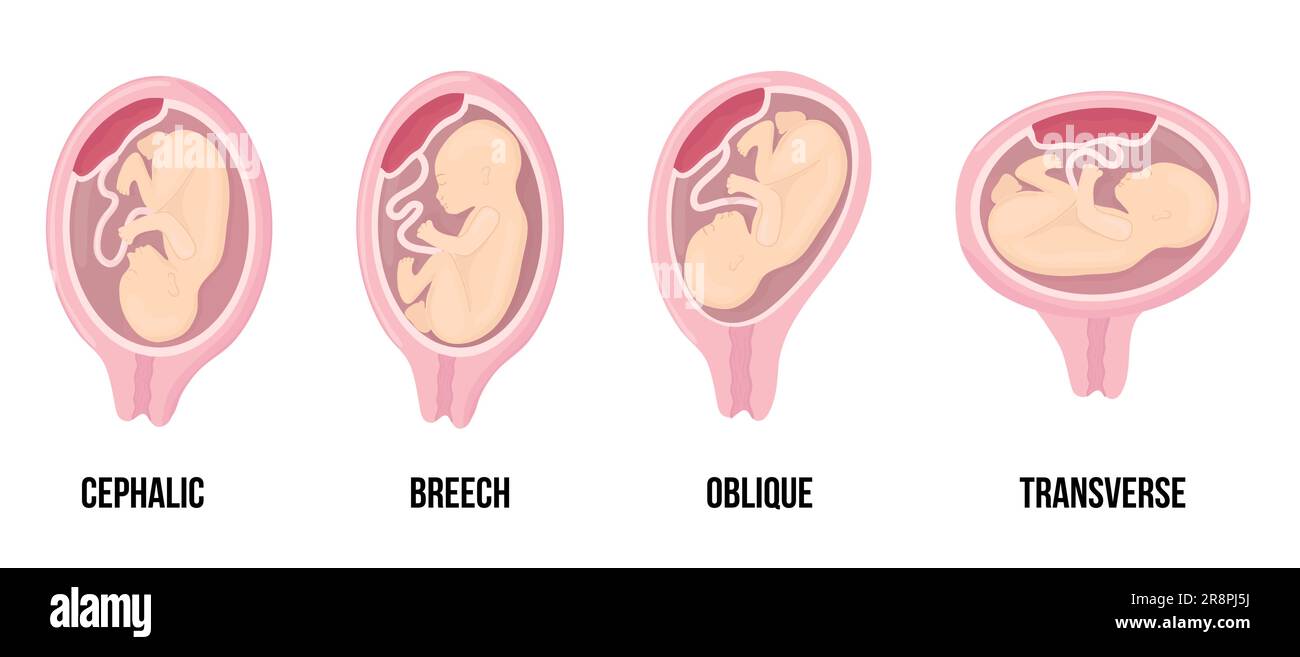 Différentes positions incorrectes du bébé dans l'utérus pendant la grossesse. Les mensonges céphaliques, brémécaniques, transversaux, obliques. Illustration vectorielle médicale colorée. Fœtus avec Illustration de Vecteur