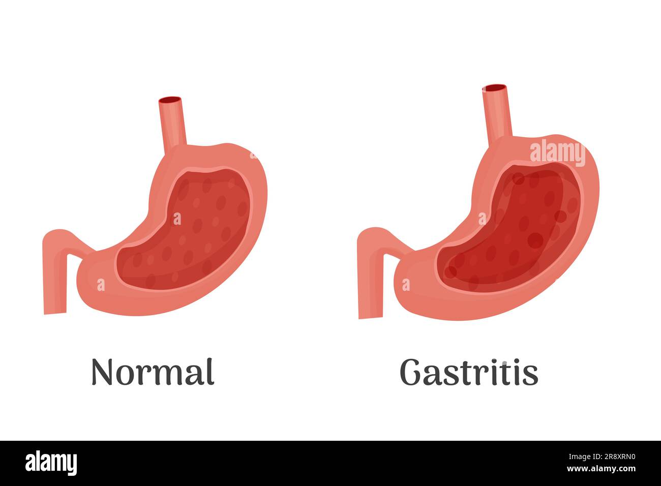 Anatomie de l'estomac sain et malsain humain, affiche médicale avec un diagramme détaillé de la structure de l'intérieur de l'estomac, maladies du système digestif - normal et gastrite. Illustration vectorielle Illustration de Vecteur