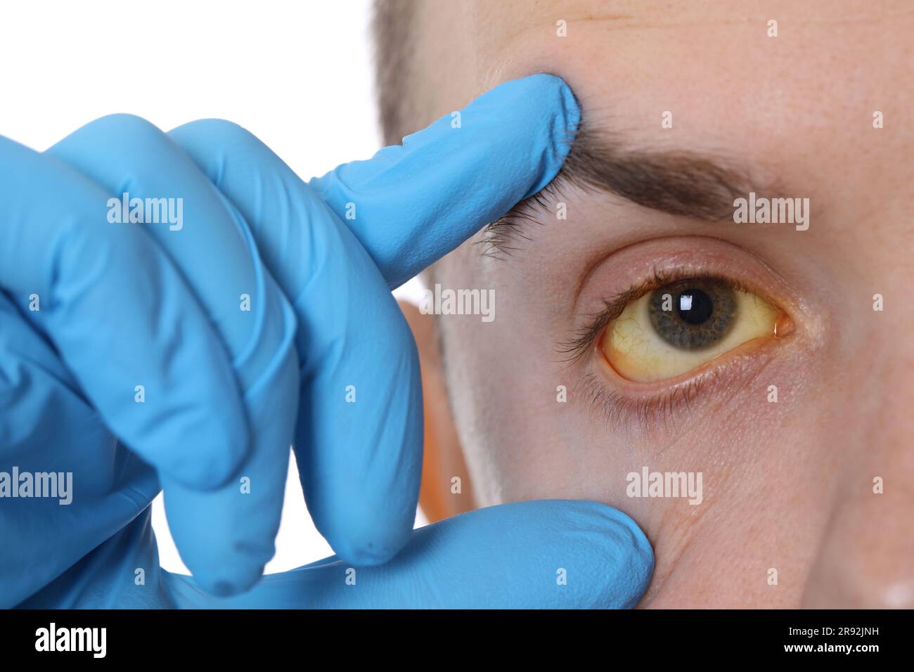 Homme vérifiant son état de santé sur fond blanc, gros plan. Yeux jaunes comme symptôme de l'hépatite Banque D'Images