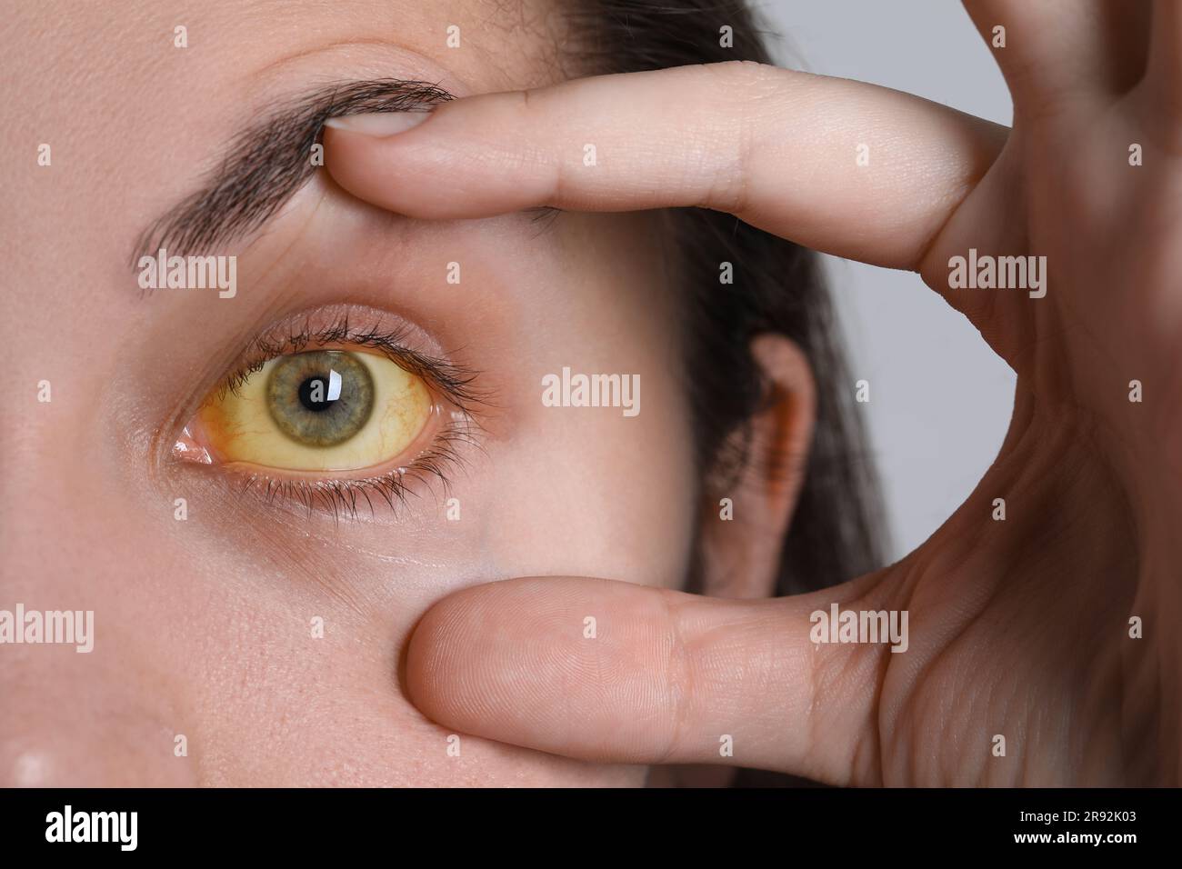 Femme avec des yeux jaunes sur fond clair, gros plan. Symptôme de l'hépatite Banque D'Images