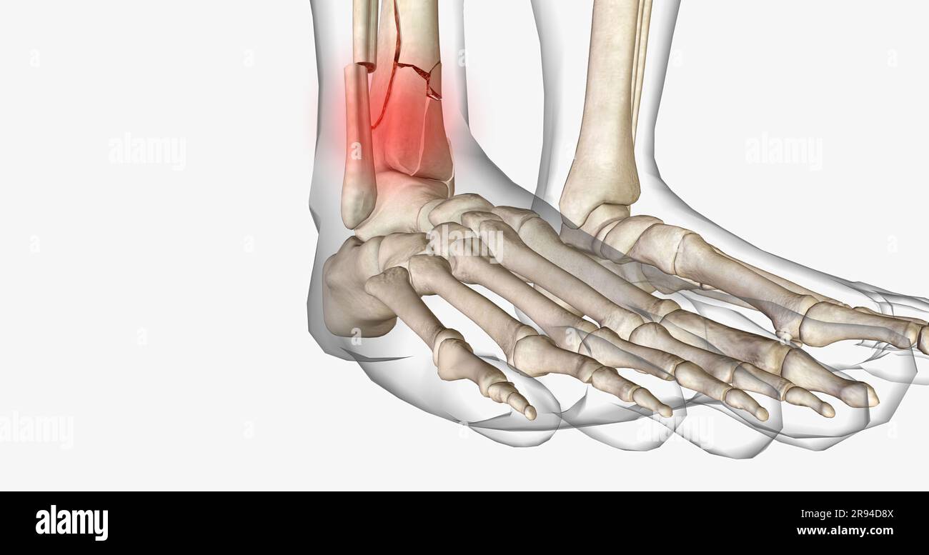 Les fractures du tibia distal affectent l