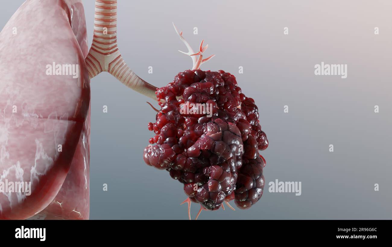 Pneumonie maladie, poumons sains et maladies poumons, cancer des poumons humains, fumeurs de cigarettes maladie pulmonaire, tumeur maligne cancéreuse en croissance et propagation Banque D'Images