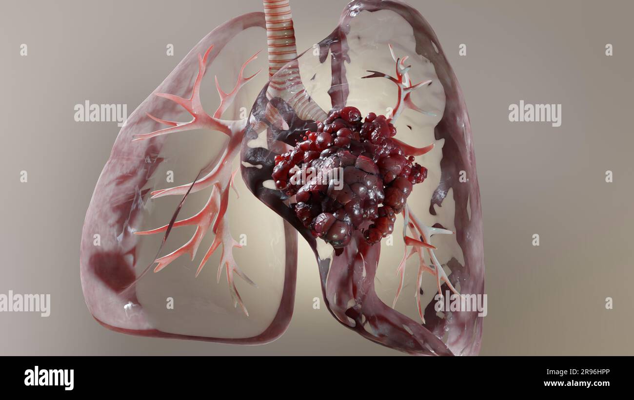 Pneumonie maladie, poumons sains et maladies poumons, cancer des poumons humains, fumeurs de cigarettes maladie pulmonaire, tumeur maligne cancéreuse en croissance et propagation Banque D'Images