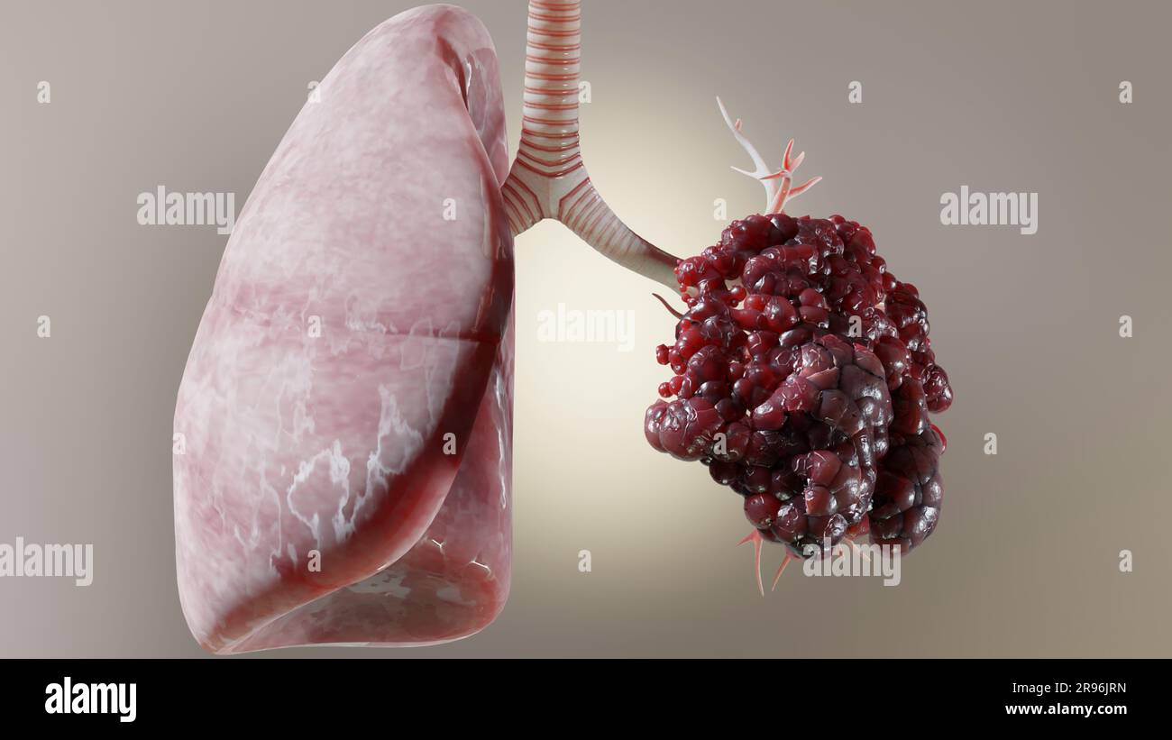 Pneumonie maladie, poumons sains et maladies poumons, cancer des poumons humains, fumeurs de cigarettes maladie pulmonaire, tumeur maligne cancéreuse en croissance et propagation Banque D'Images