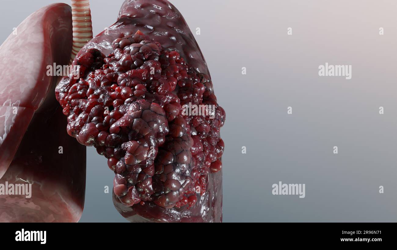 Pneumonie maladie, poumons sains et maladies poumons, cancer des poumons humains, fumeurs de cigarettes maladie pulmonaire, tumeur maligne cancéreuse en croissance et propagation Banque D'Images