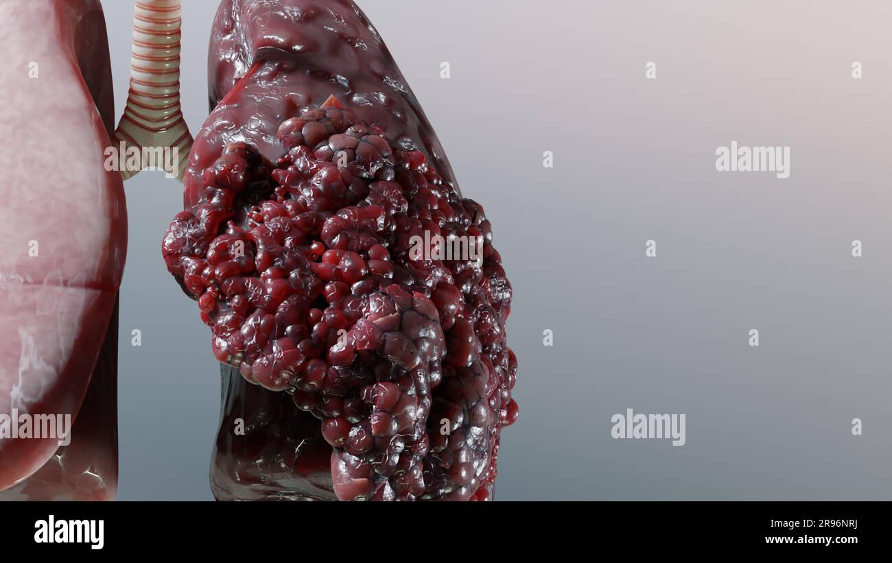 Pneumonie maladie, poumons sains et maladies poumons, cancer des poumons humains, fumeurs de cigarettes maladie pulmonaire, tumeur maligne cancéreuse en croissance et propagation Banque D'Images