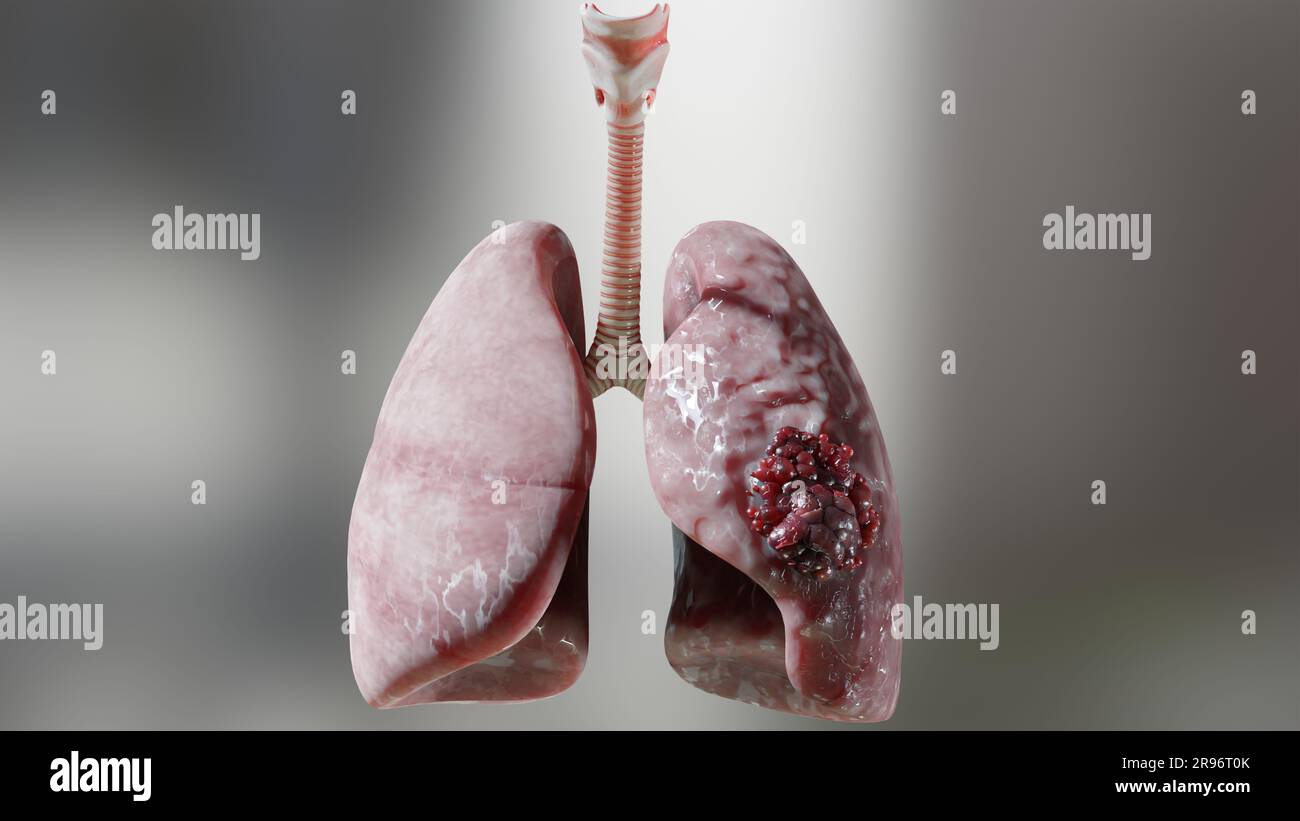 Pneumonie maladie, poumons sains et maladies poumons, cancer des poumons humains, fumeurs de cigarettes maladie pulmonaire, tumeur maligne cancéreuse en croissance et propagation Banque D'Images