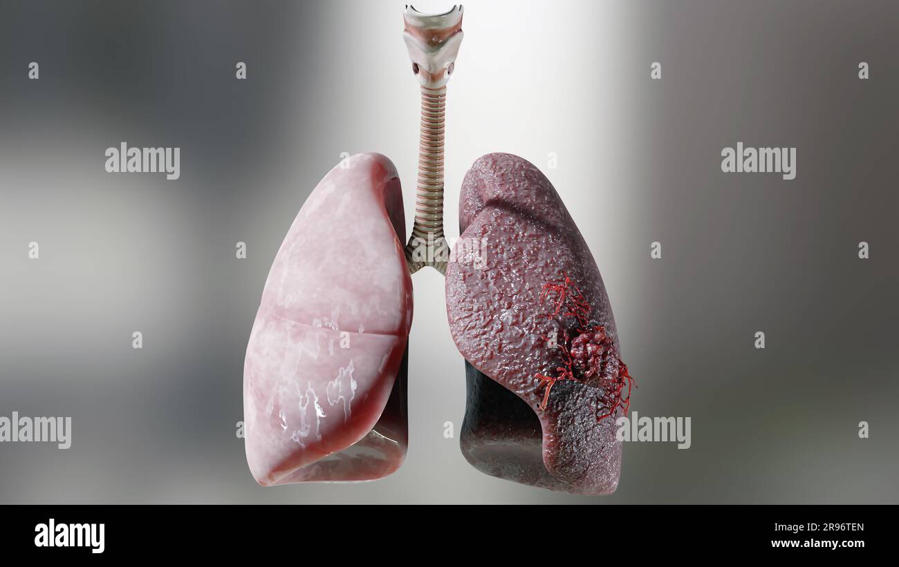 Pneumonie maladie, poumons sains et maladies poumons, cancer des poumons humains, fumeurs de cigarettes maladie pulmonaire, tumeur maligne cancéreuse en croissance et propagation Banque D'Images