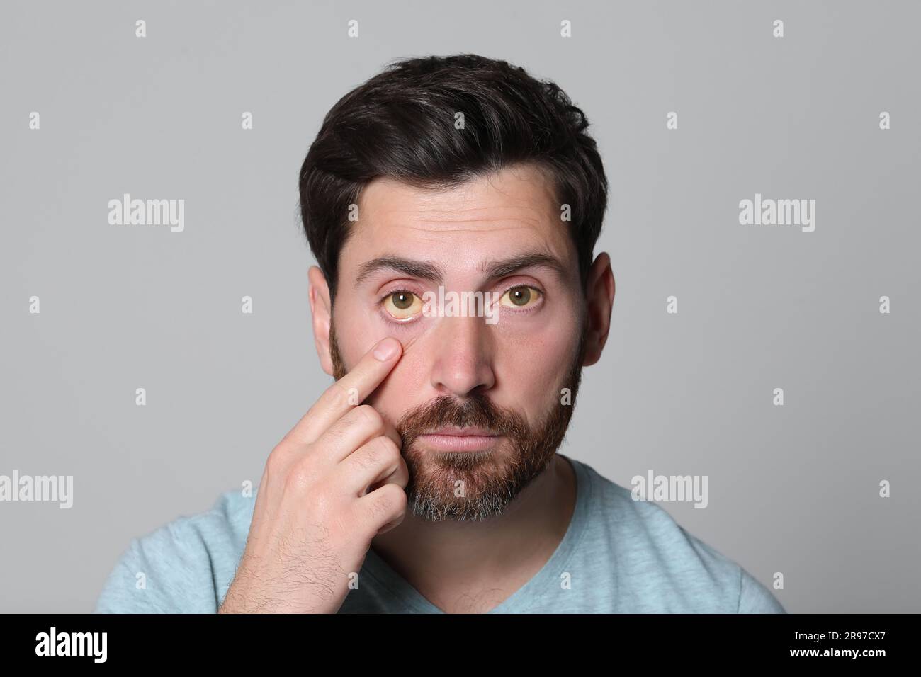 Homme avec des yeux jaunes sur fond gris. Symptôme de l'hépatite Banque D'Images