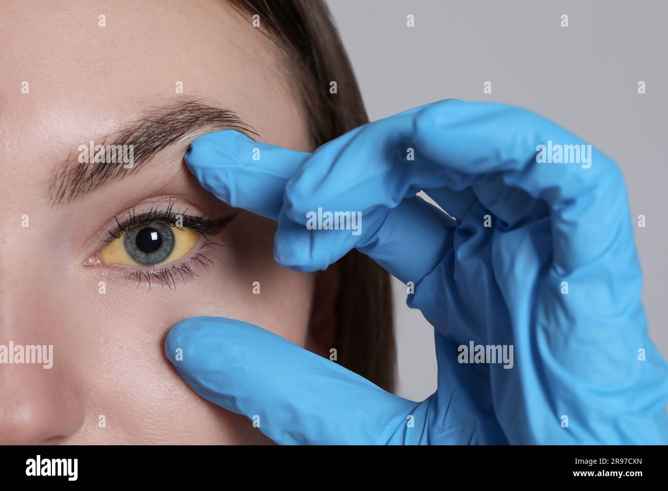 Femme vérifiant son état de santé sur fond gris clair, gros plan. Yeux jaunes comme symptôme de l'hépatite Banque D'Images