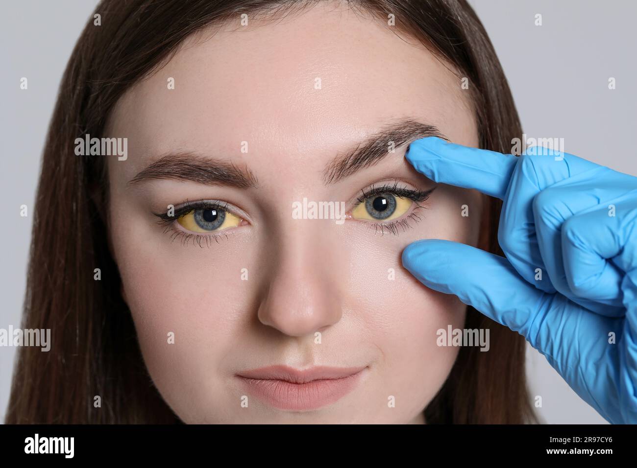 Femme vérifiant son état de santé sur fond gris clair, gros plan. Yeux jaunes comme symptôme de l'hépatite Banque D'Images