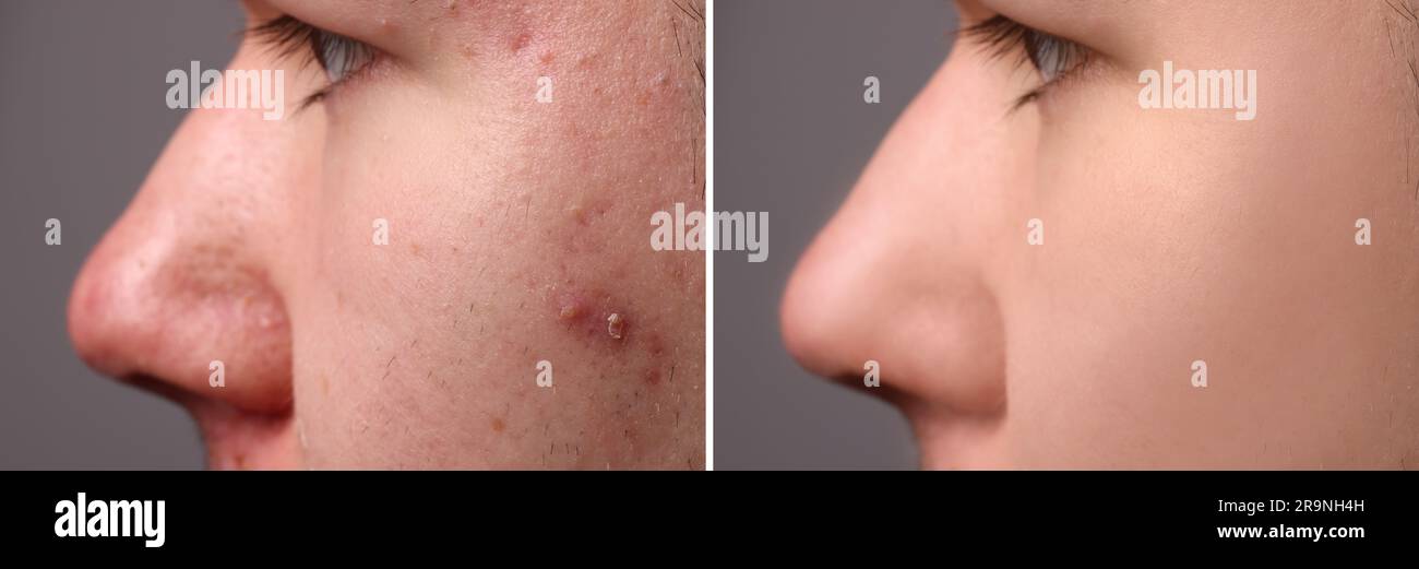 Avant et après le traitement de l'acné. Photos de l'homme sur fond gris, gros plan. Collage montrant une peau atteinte et saine Banque D'Images