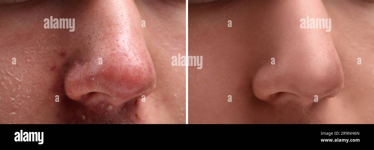 Photos de l'homme avant et après le traitement de l'acné, gros plan. Collage montrant une peau atteinte et saine Banque D'Images