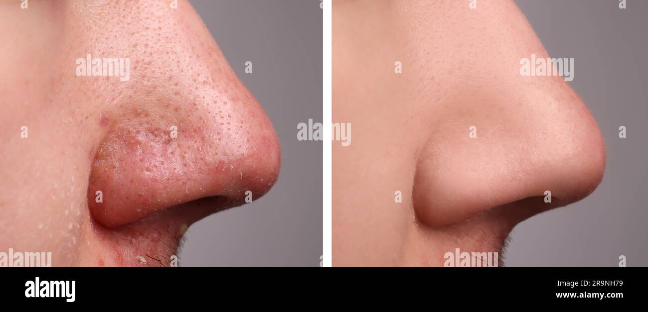 Avant et après le traitement de l'acné. Photos de l'homme sur fond gris, gros plan. Collage montrant une peau atteinte et saine Banque D'Images