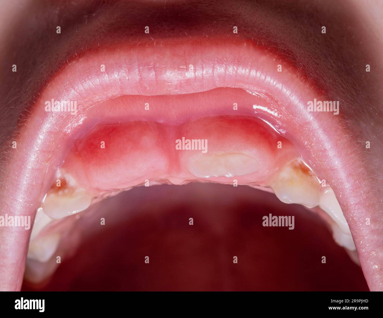 Enflure des gencives pendant l'éruption des dents permanentes après la perte des dents de lait chez les enfants. Dentisterie pour enfants. Banque D'Images