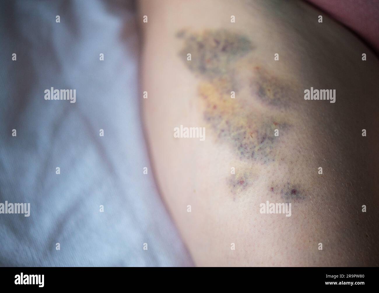 Ecchymoses sur la peau de la jambe du patient après des injections intramusculaires du médicament. Traitement des joints et des ecchymoses après injections, gros plan Banque D'Images