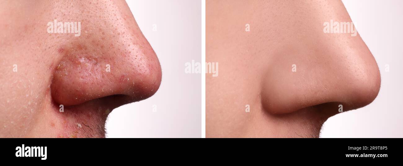 Avant et après le traitement de l'acné. Photos de l'homme sur fond blanc, gros plan. Collage montrant une peau atteinte et saine Banque D'Images