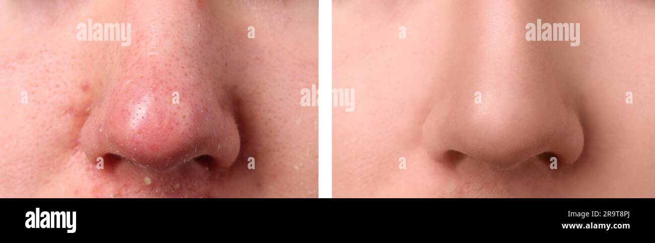 Photos de l'homme avant et après le traitement de l'acné, gros plan. Collage montrant une peau atteinte et saine Banque D'Images