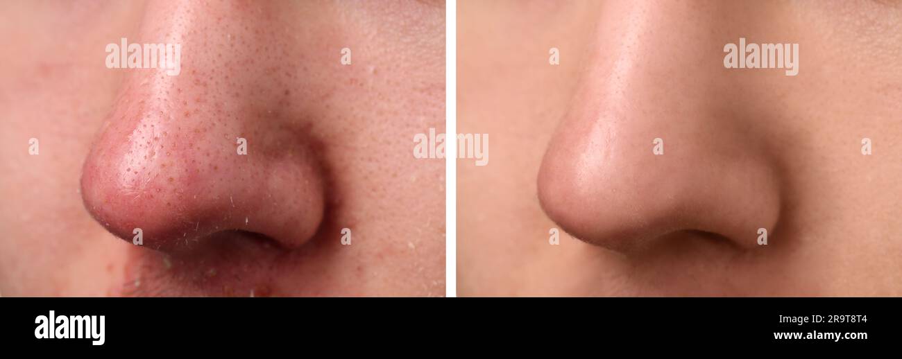 Photos de l'homme avant et après le traitement de l'acné, gros plan. Collage montrant une peau atteinte et saine Banque D'Images