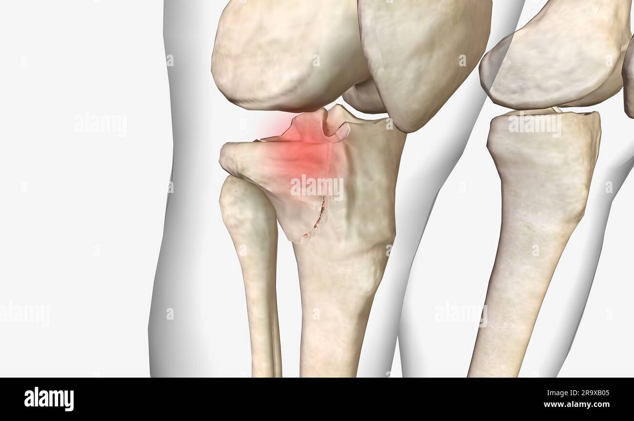 Les fractures du tibia proximal, également appelées fractures du plateau tibial, affectent le