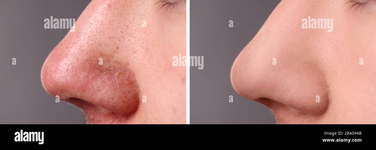 Avant et après le traitement de l'acné. Photos de l'homme sur fond gris, gros plan. Collage montrant une peau atteinte et saine Banque D'Images