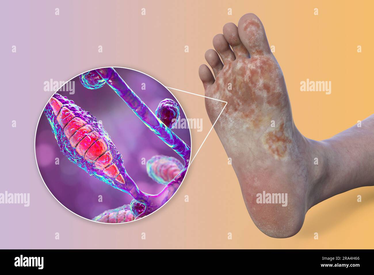Microsporum canis infection du pied, illustration Banque D'Images