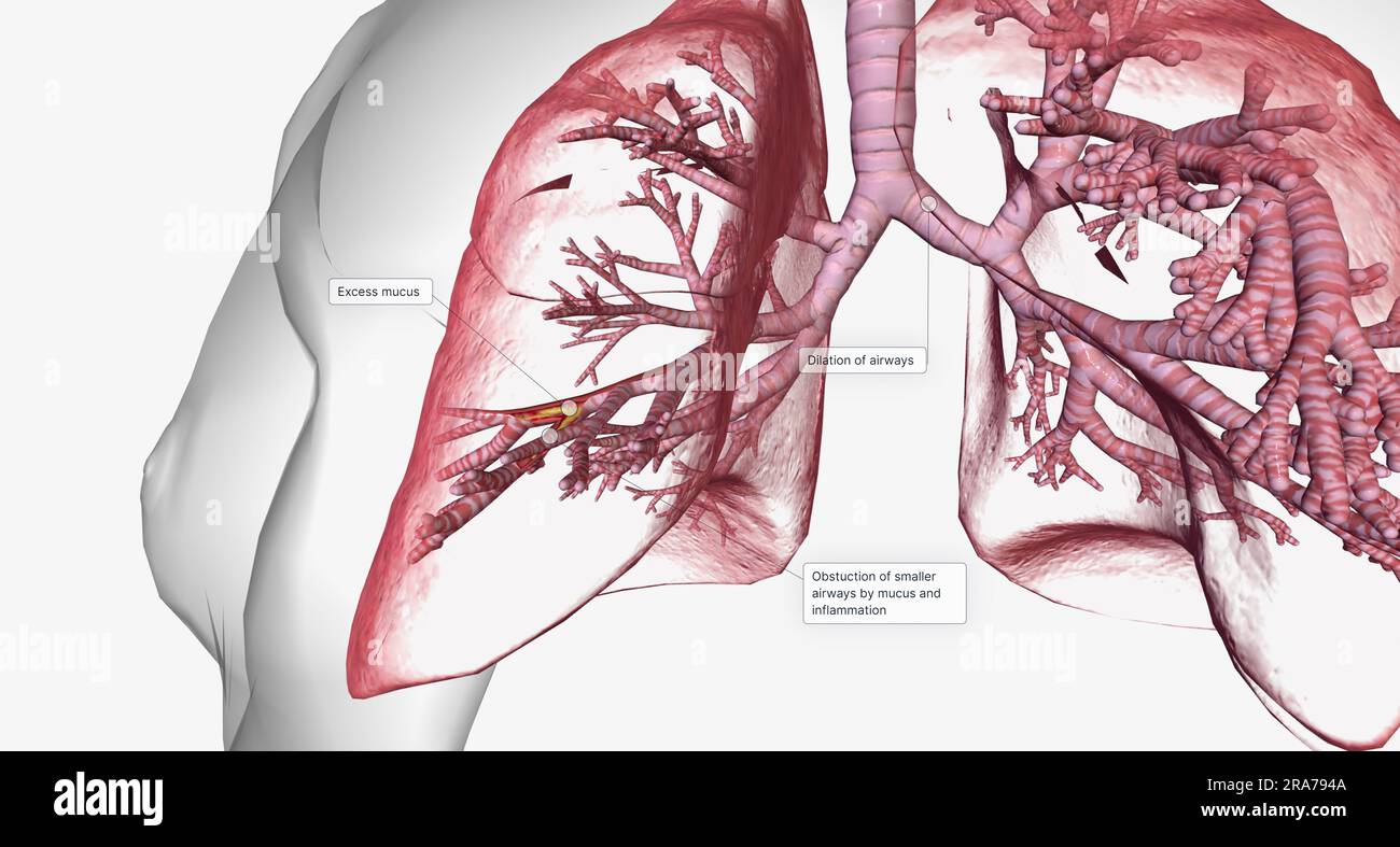 Bronchiectasie, affectant les poumons, caractérisée par des voies