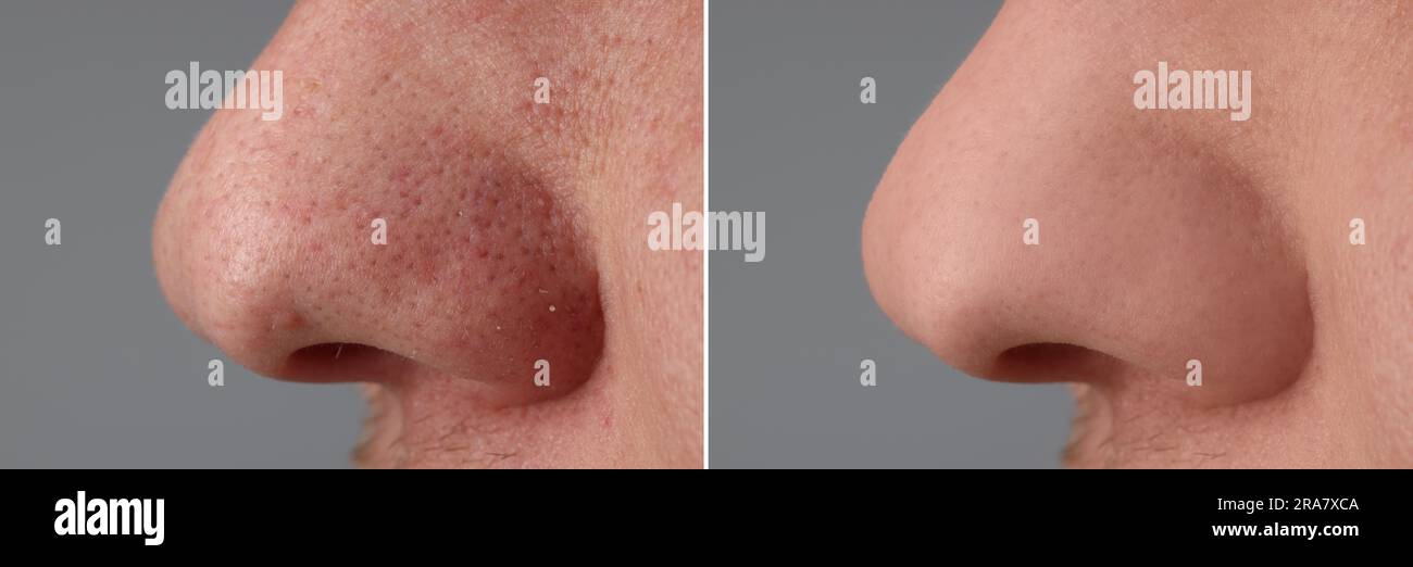 Avant et après le traitement de l'acné. Photos de l'homme sur fond gris, gros plan. Collage montrant une peau atteinte et saine Banque D'Images