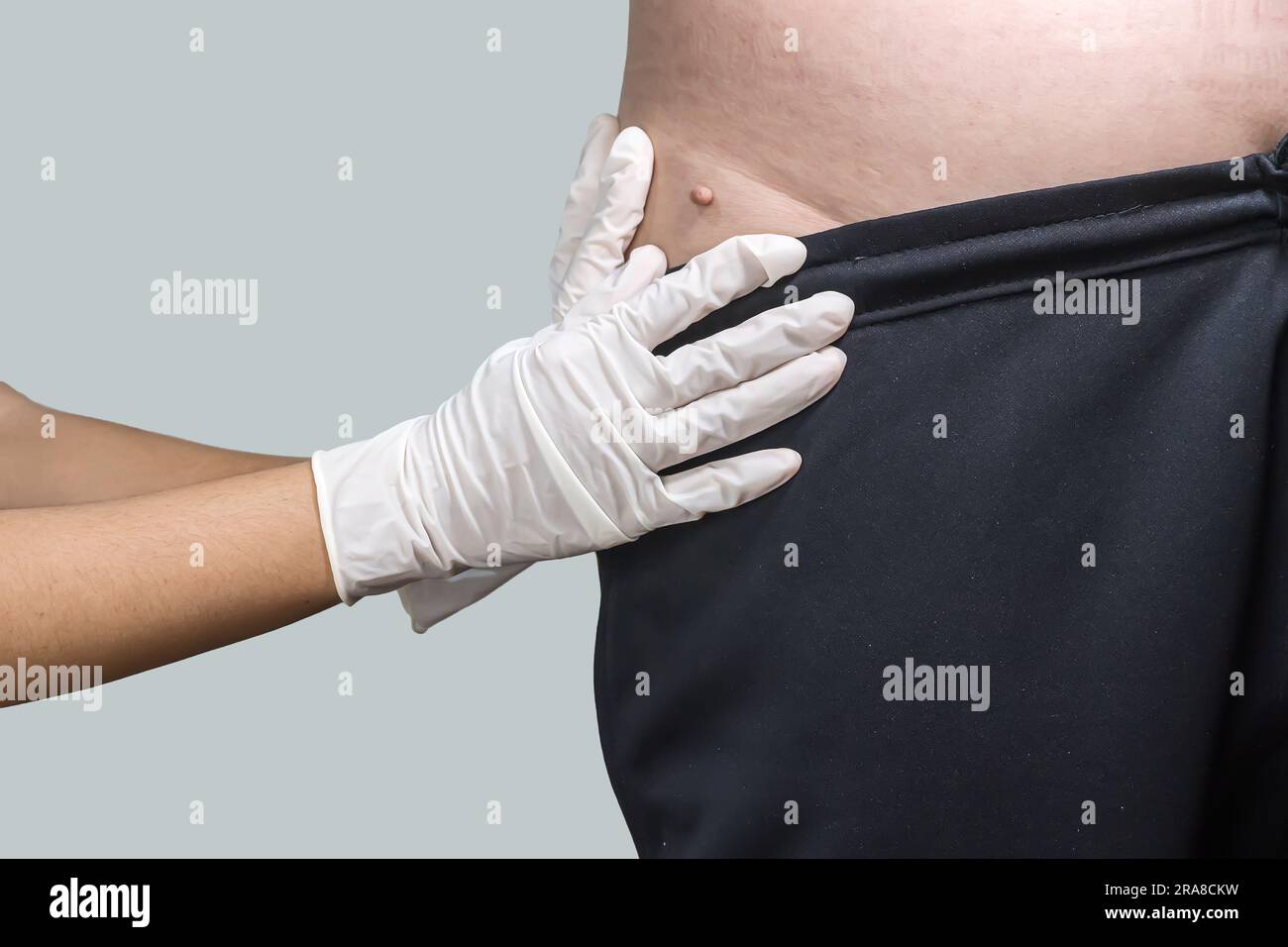 Étiquette de peau ou acrochondon ou fibrome mou est un coffre-fort. Il n'ont pas effet à l'organisme. Elle se produit habituellement au cou, le visage, les aisselles et le corps. Banque D'Images