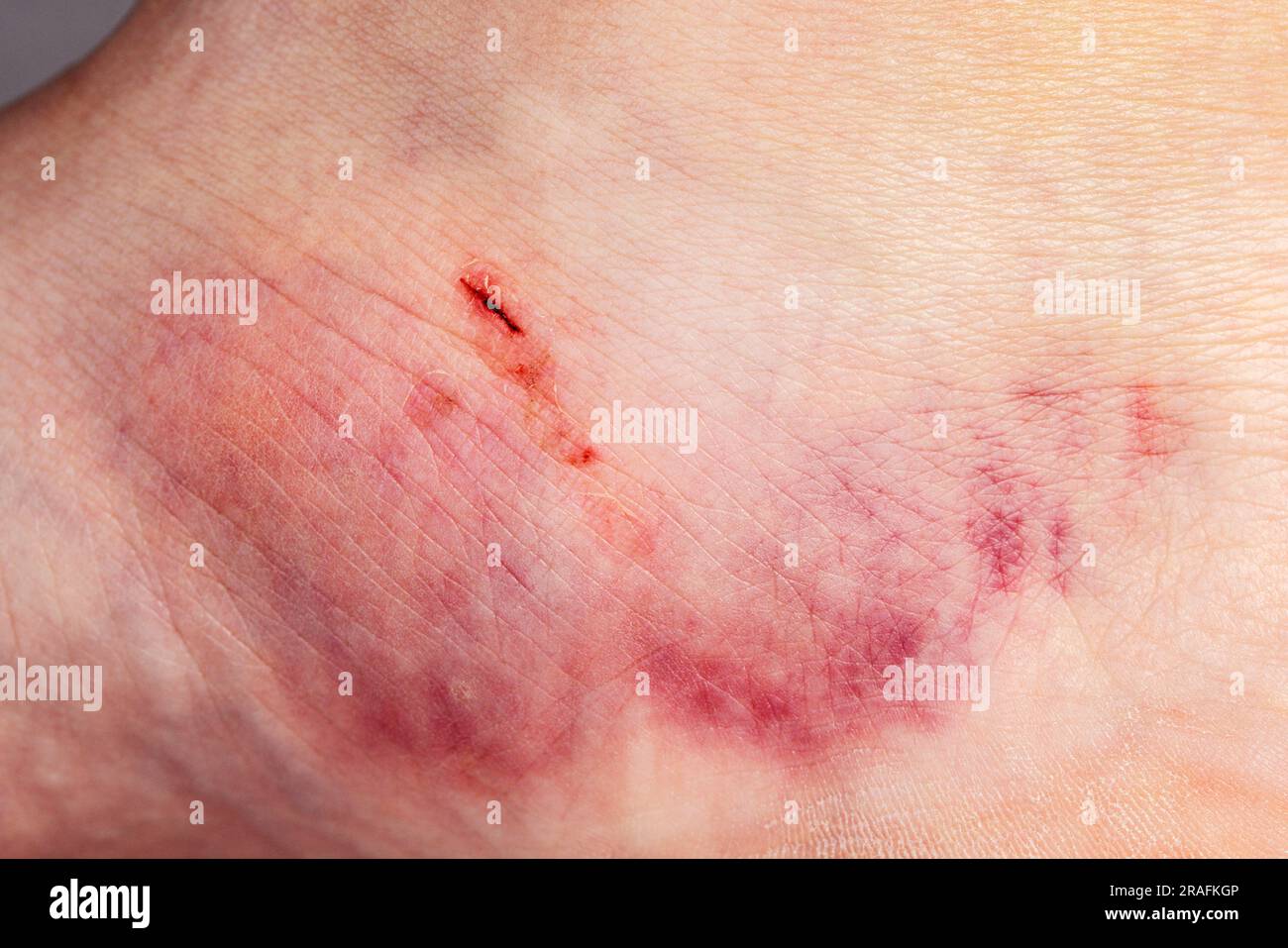 Gros plan sur l'ecchymose sur la peau de la jambe d'une femme blessée. Banque D'Images