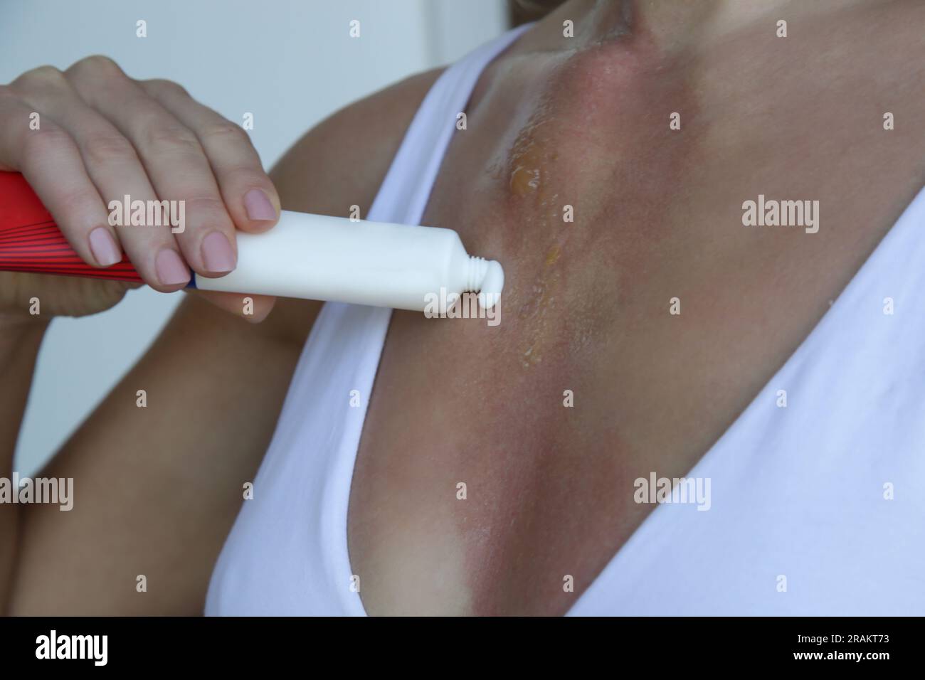 Femme appliquant de la pommade sur une brûlure au deuxième degré avec une cloque sur sa poitrine Banque D'Images