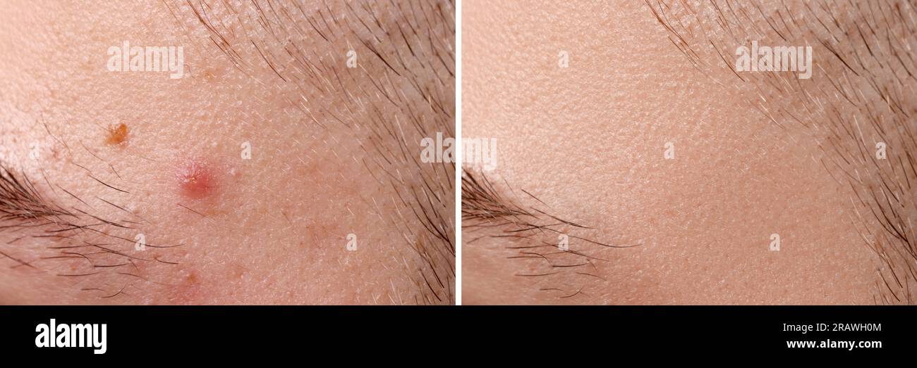 Collage avec des photos d'homme avec problème d'acné avant et après le traitement, gros plan. Conception de bannière Banque D'Images