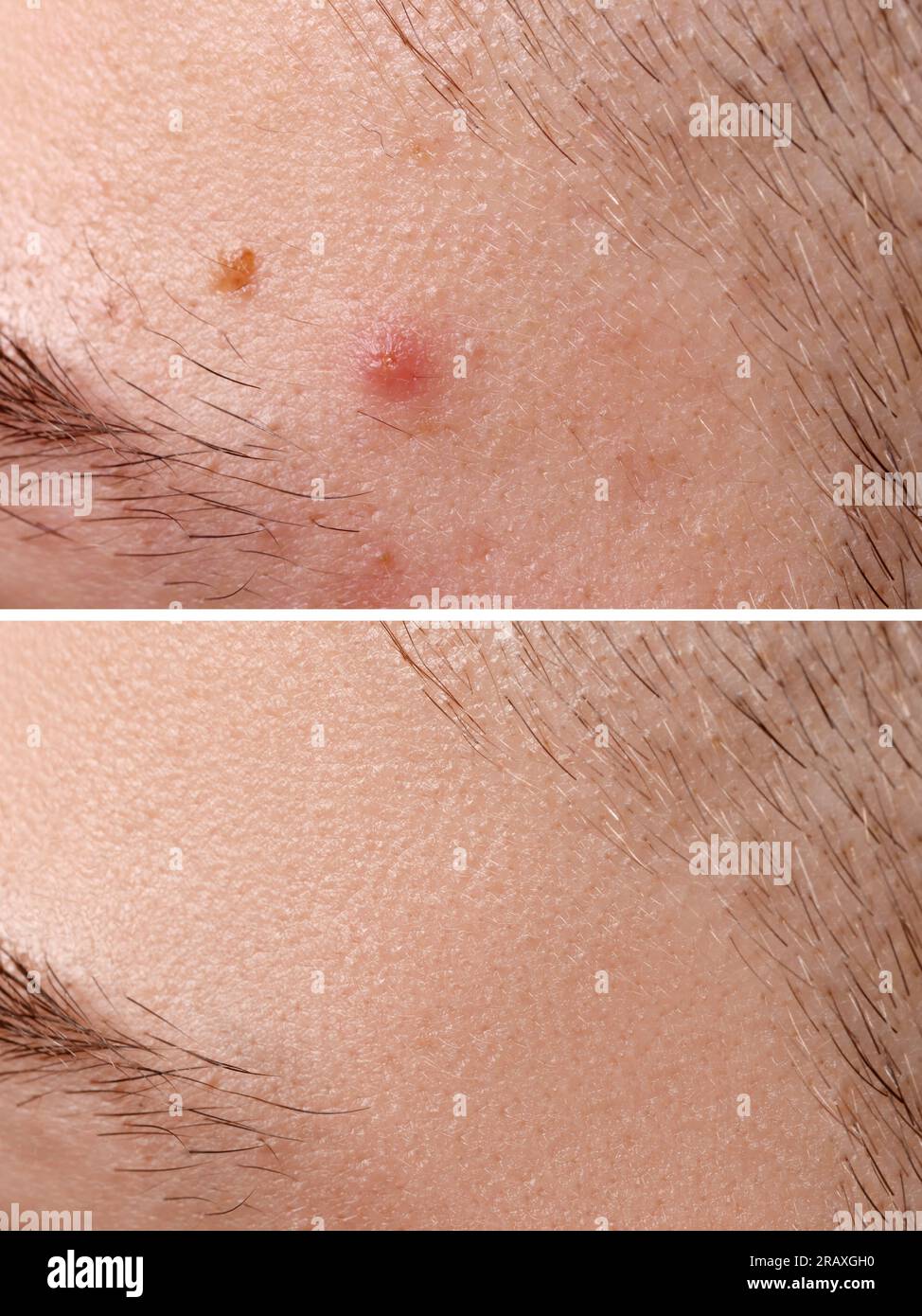 Collage avec des photos d'homme avec problème d'acné avant et après le traitement, gros plan Banque D'Images