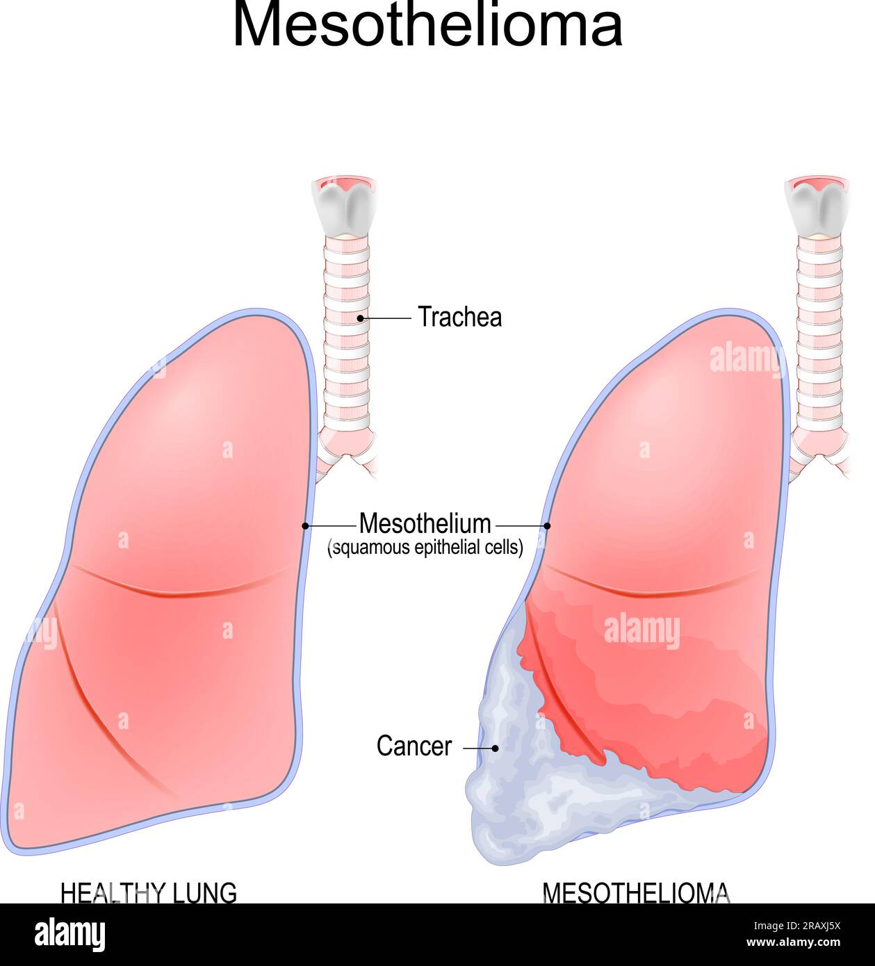 Mésothéliome. cancer qui se développe à partir de la fine couche de tissu pulmonaire - mésothélium. Tumeur maligne causée par exposition à l'amiante, génétique Illustration de Vecteur