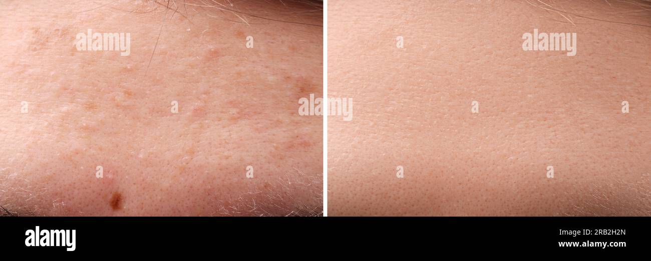 Collage avec des photos de femme avec problème d'acné avant et après le traitement, gros plan. Conception de bannière Banque D'Images