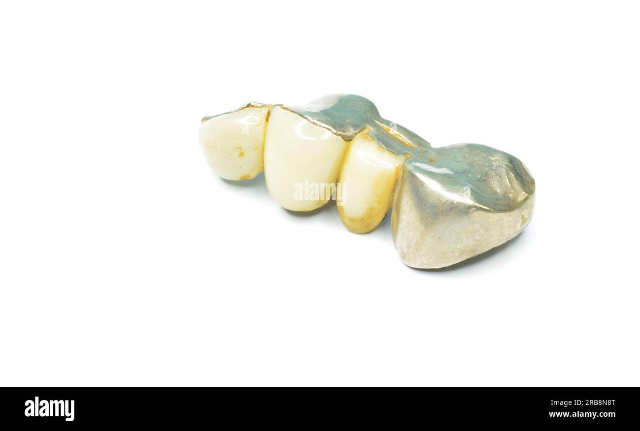 Couronne dentaire vintage en porcelaine et métal sur fond blanc Banque D'Images