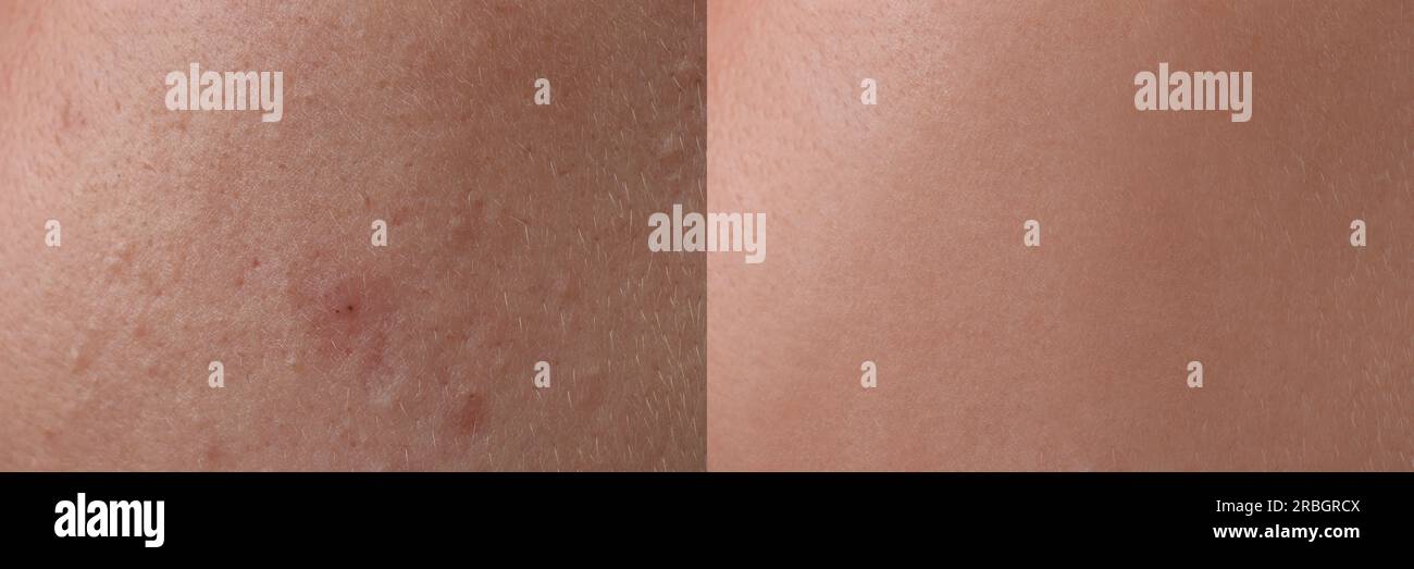 Collage avec des photos de personne souffrant d'acné avant et après le traitement, gros plan. Conception de bannière montrant la peau affectée et saine Banque D'Images