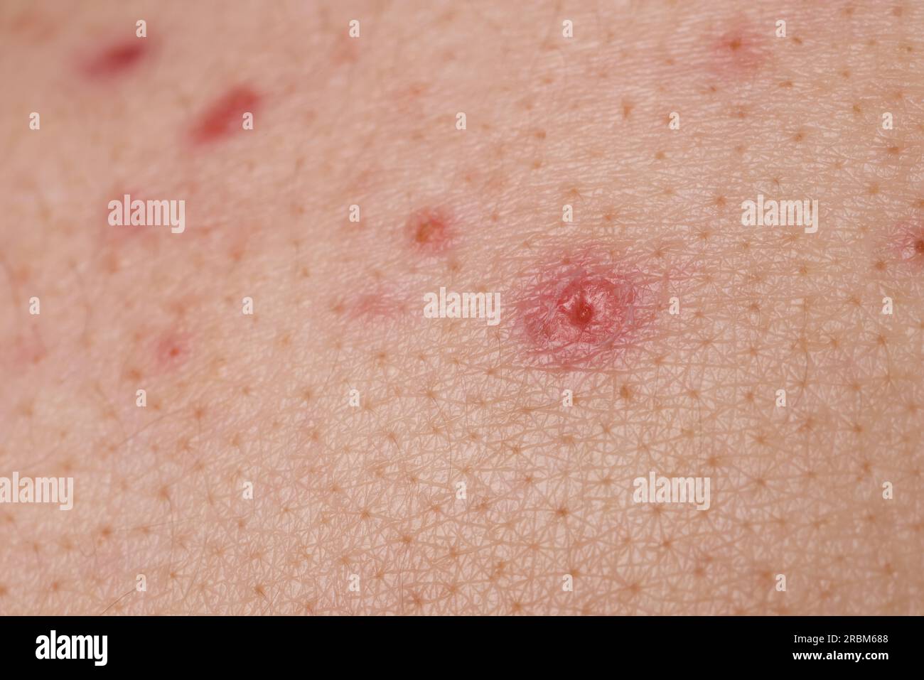 Jeune personne avec problème d'acné, vue rapprochée de la peau Banque D'Images