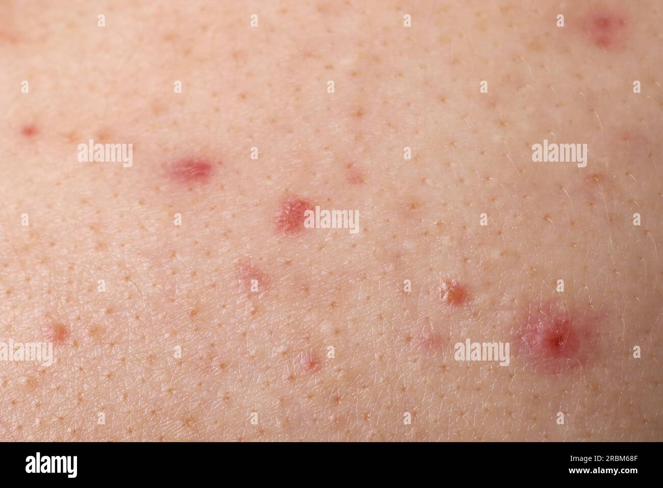 Jeune personne avec problème d'acné, vue rapprochée de la peau Banque D'Images