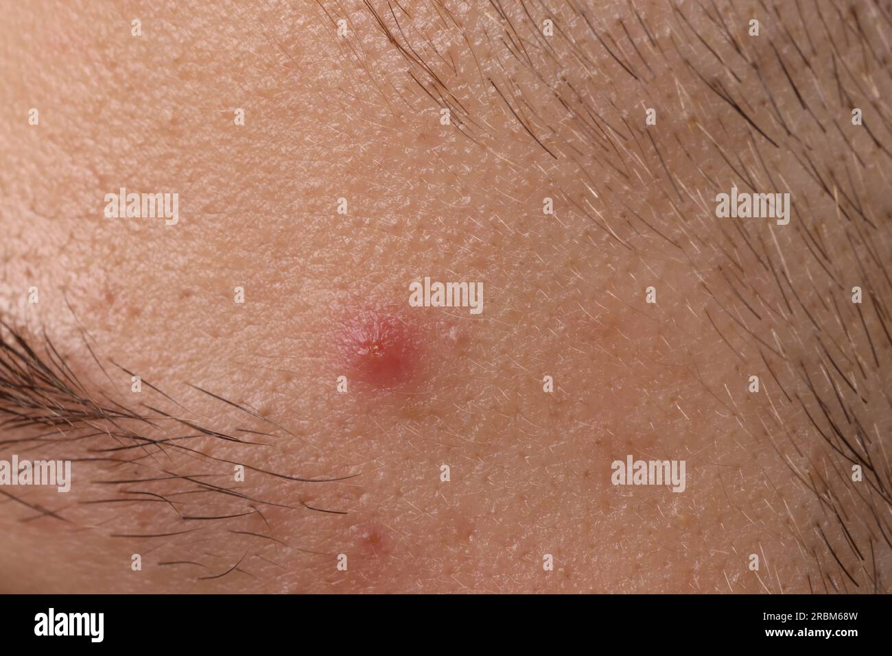 Jeune homme avec problème d'acné, vue rapprochée Banque D'Images