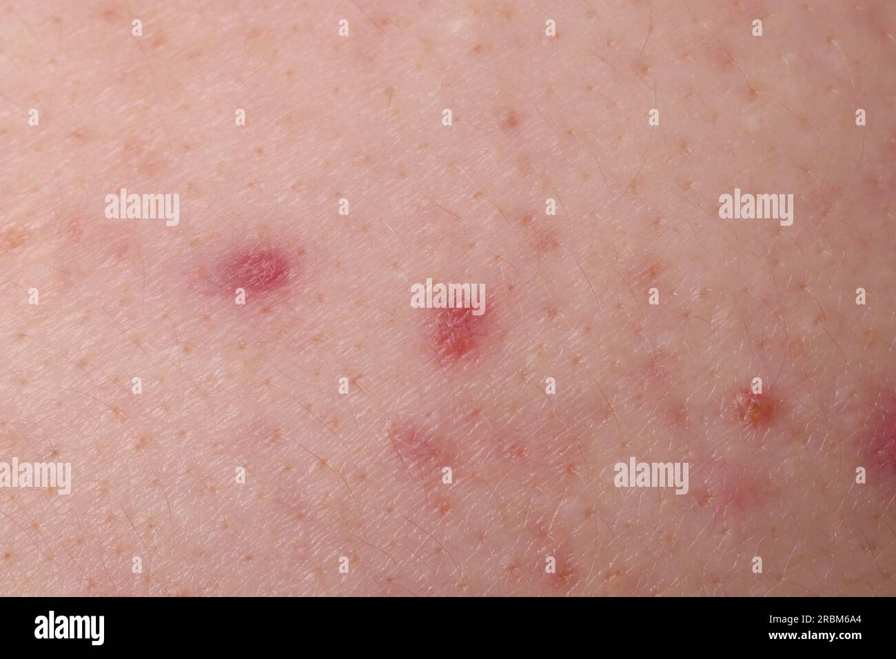 Jeune personne avec problème d'acné, vue rapprochée de la peau Banque D'Images