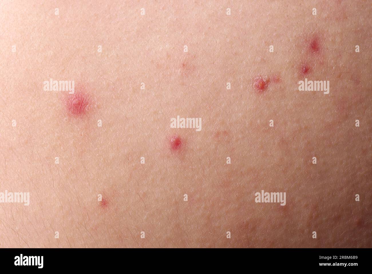 Jeune personne avec problème d'acné, vue rapprochée de la peau Banque D'Images