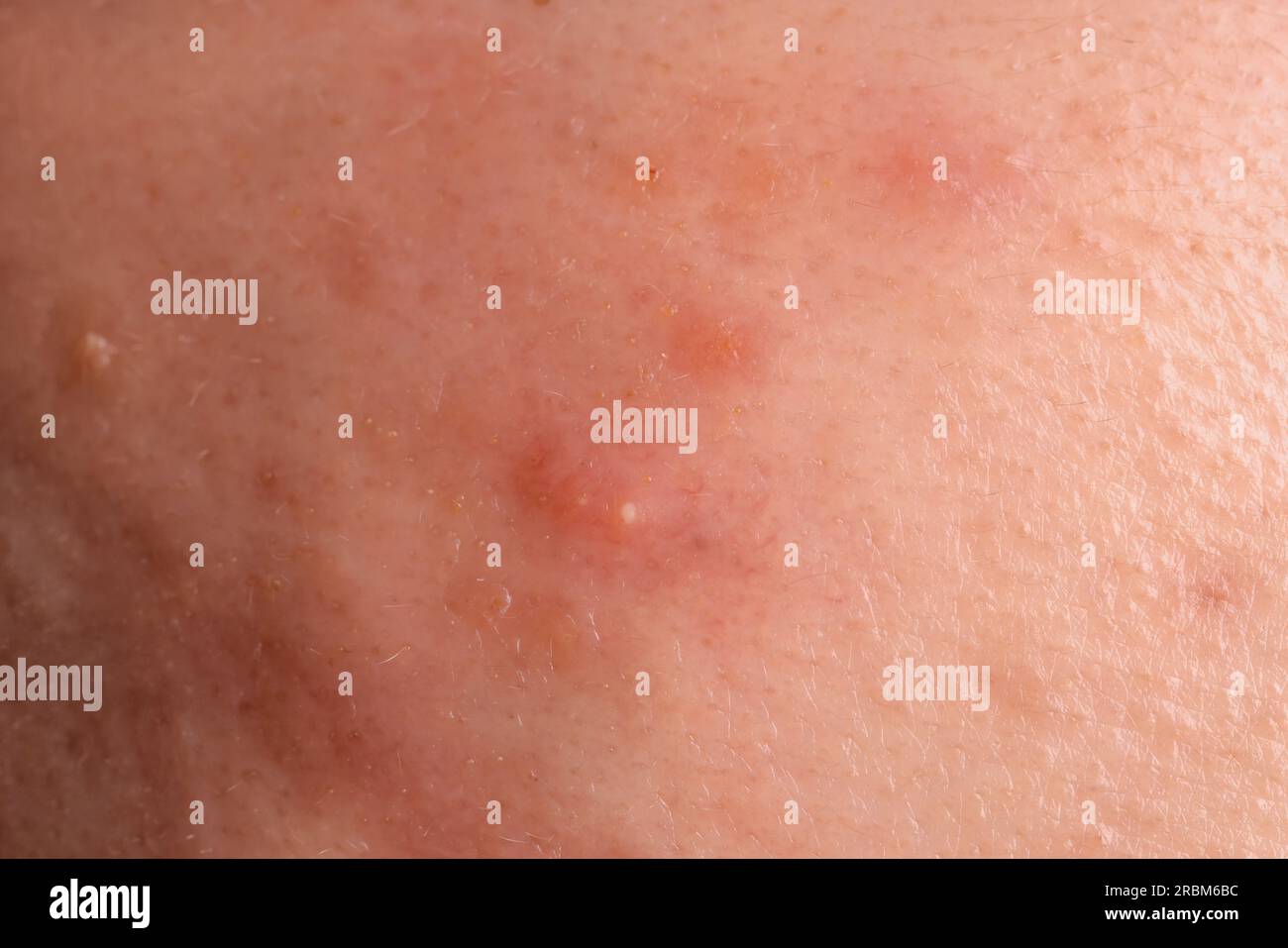 Jeune personne avec problème d'acné, vue rapprochée de la peau Banque D'Images