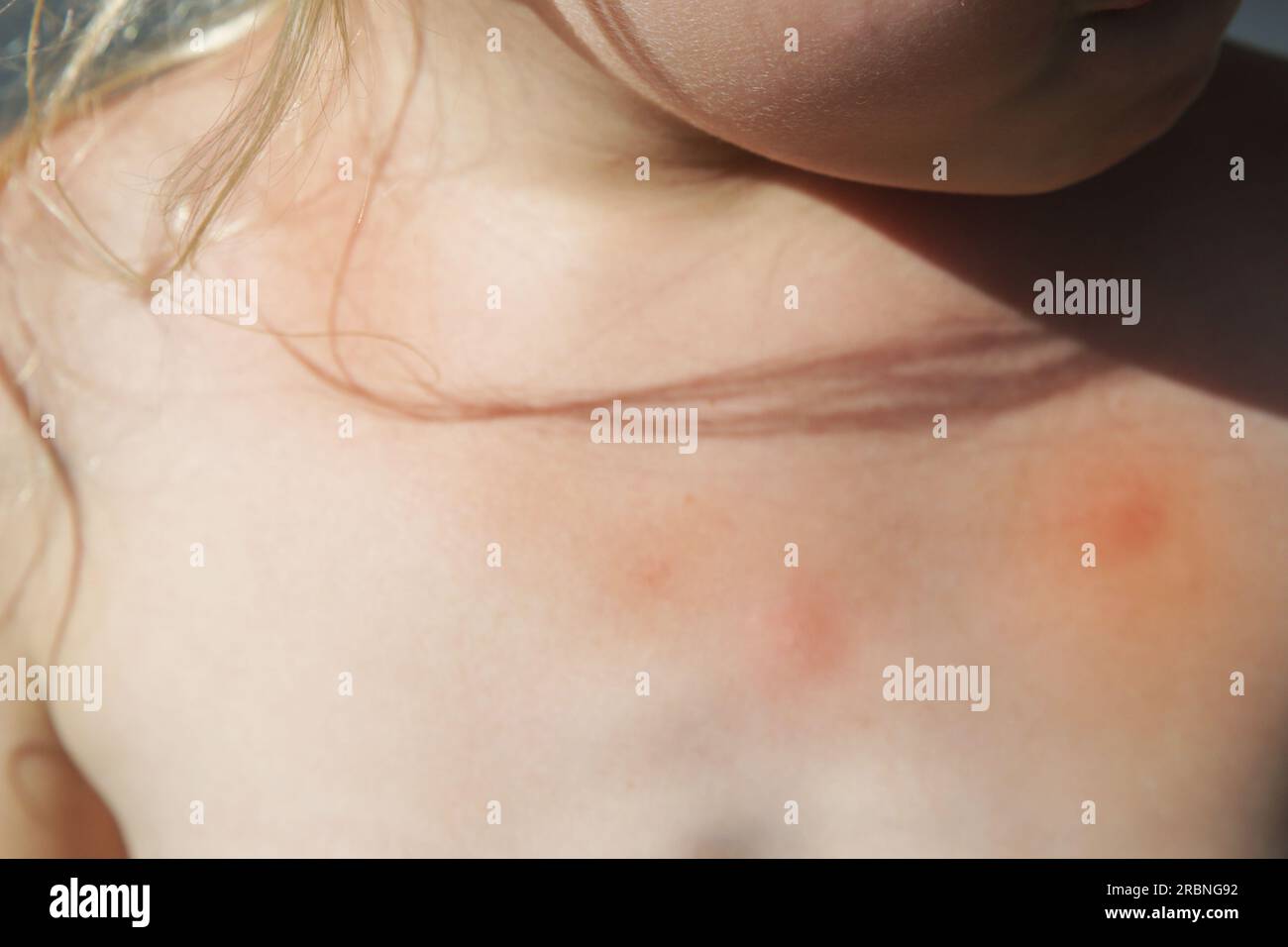 La petite fille a une éruption cutanée due à une allergie ou à des piqûres de moustiques Banque D'Images