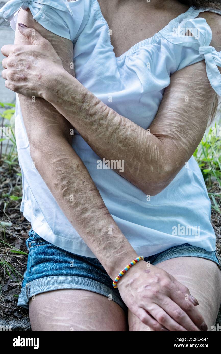 Bras d'une femme avec de lourdes coupures et des cicatrices d'automutilation dans la frustration, l'auto-abus, le trouble de la personnalité borderline. Banque D'Images