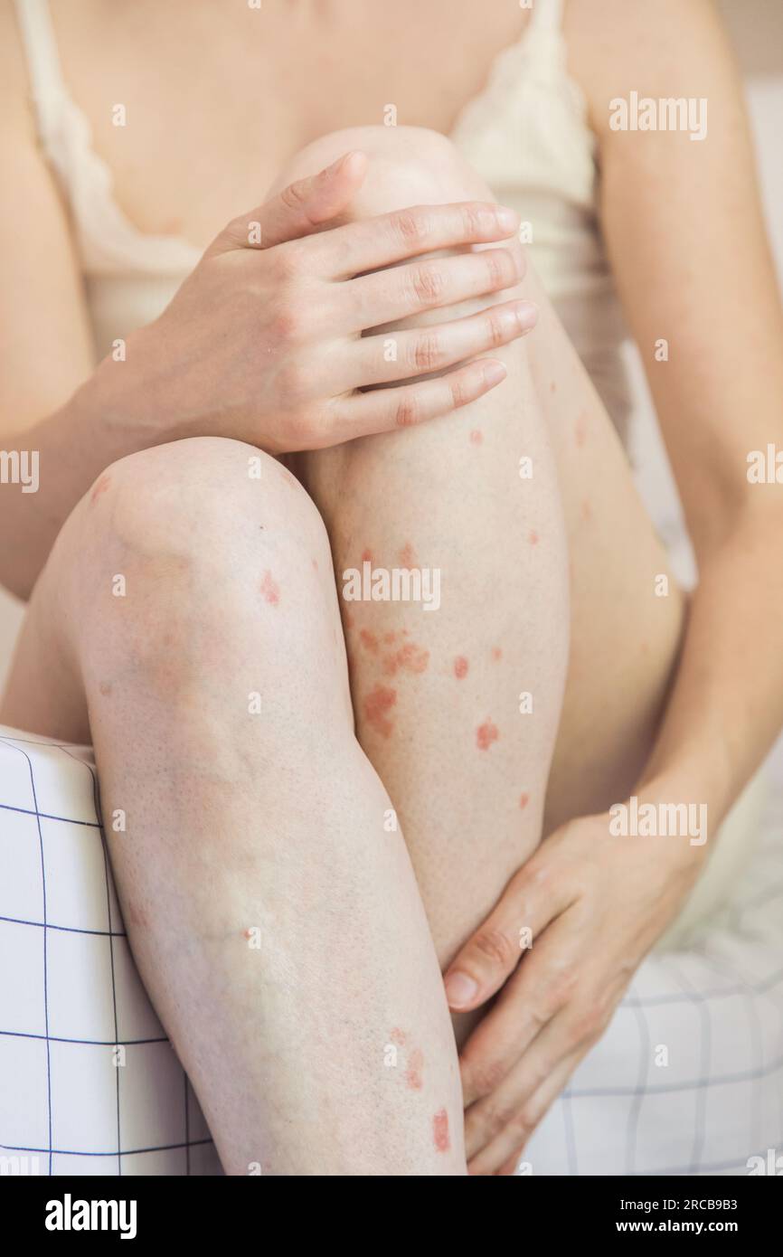 Gros plan d'une personne tenant une jambe.détail du corps de la femme caucasienne montrant l'acceptation malgré avoir des problèmes de peau.concept d'inclusion et d'estime de soi Banque D'Images