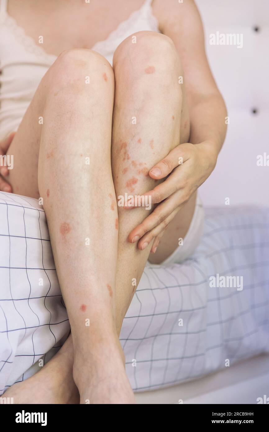 Gros plan d'une personne tenant une jambe.détail du corps de la femme caucasienne montrant l'acceptation malgré avoir des problèmes de peau.concept d'inclusion et d'estime de soi Banque D'Images