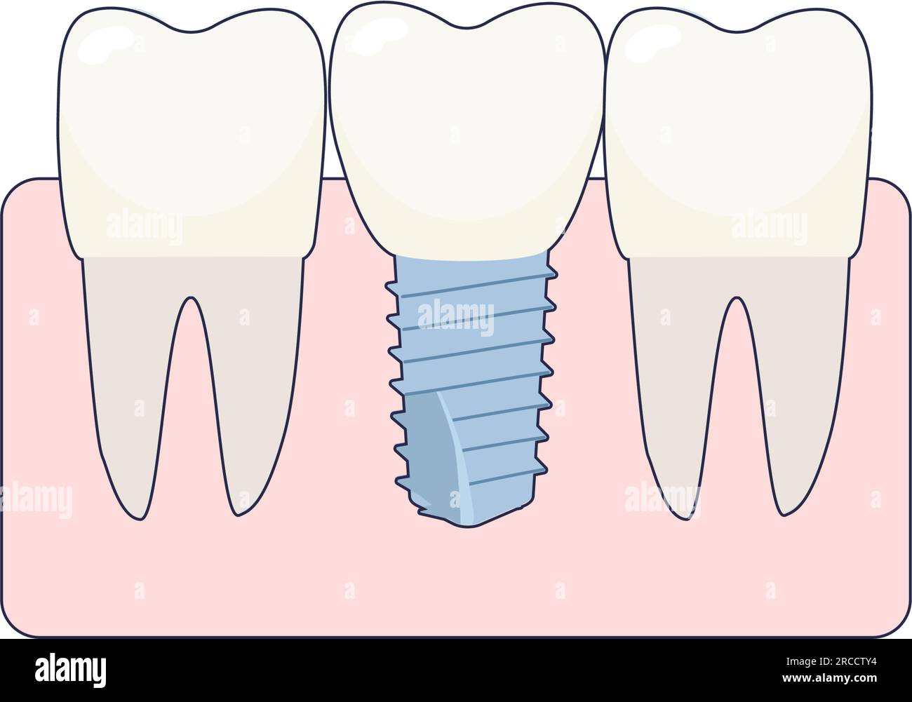 dentaire couronne silhouette et ligne icône ensemble. les dents protection  implant, médical couronne. orthodontique dentier. dentaire traitement  symbole collection. oral se soucier pictogramme. isolé vecteur  illustration. 27818195 Art vectoriel chez