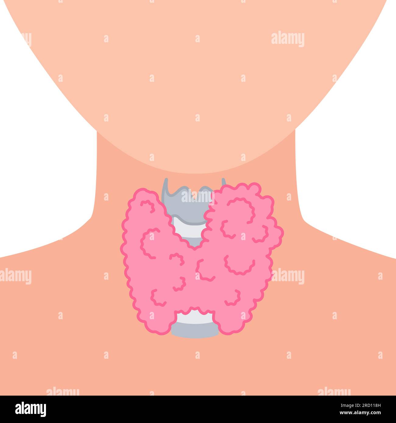 Hypertrophie de la glande thyroïde sur le schéma de silhouette du cou Illustration de Vecteur